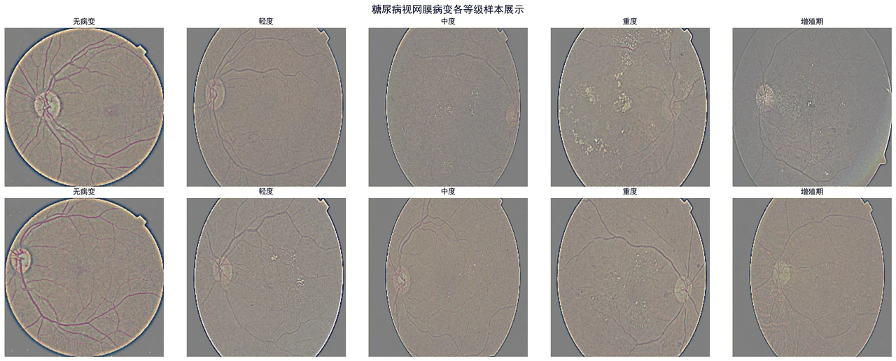 五级糖网病变眼底样本