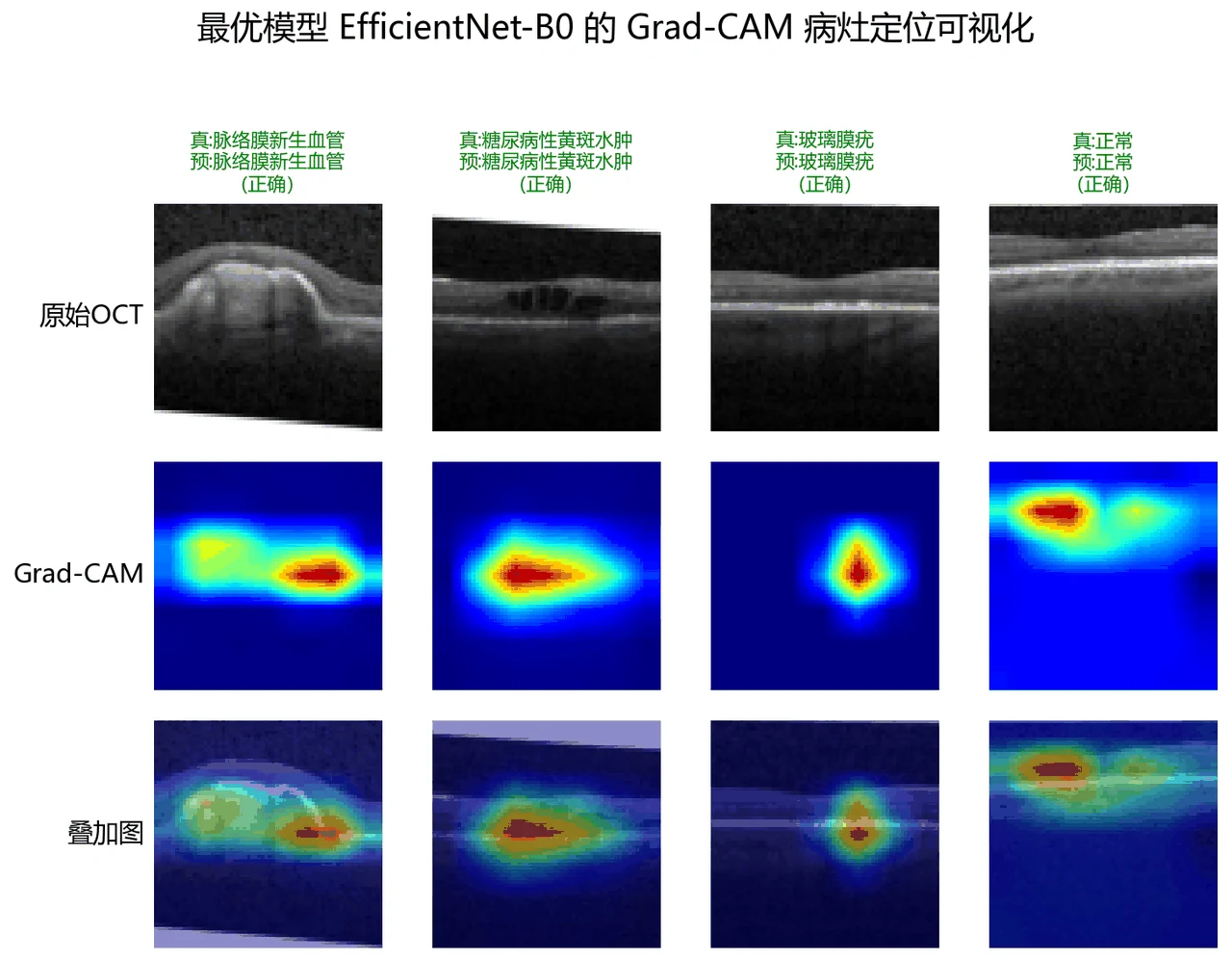 Grad-CAM 病灶定位
